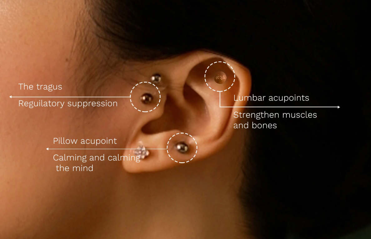 Ear acupuncture map showing Shen Men and Point Zero